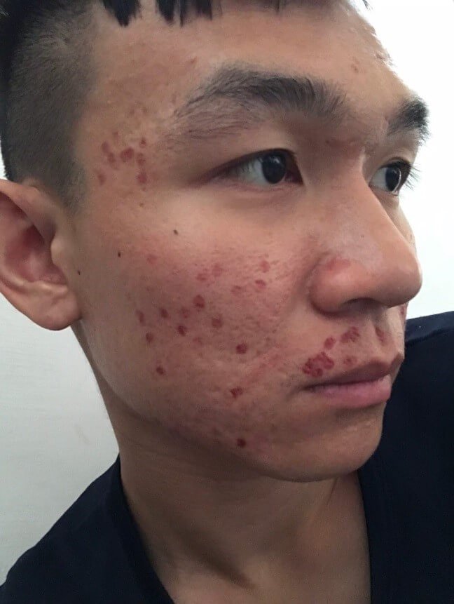 皮秒傷口