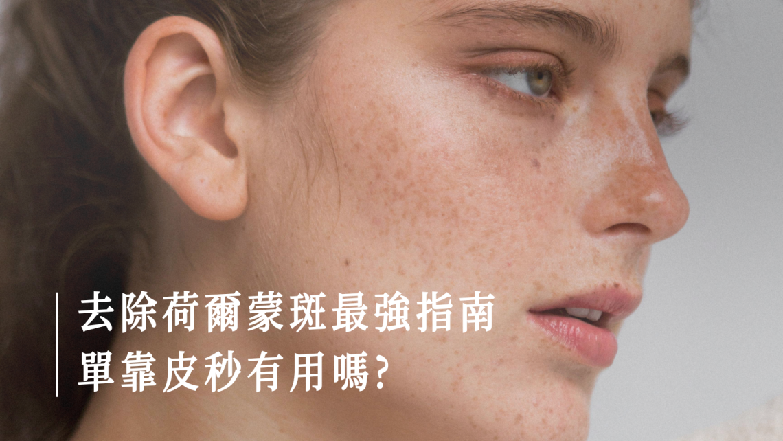 荷爾蒙斑攻略