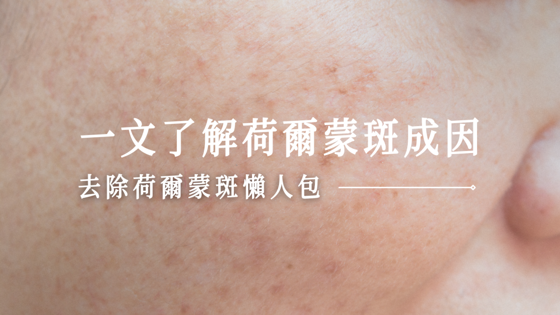 荷爾蒙斑懶人包