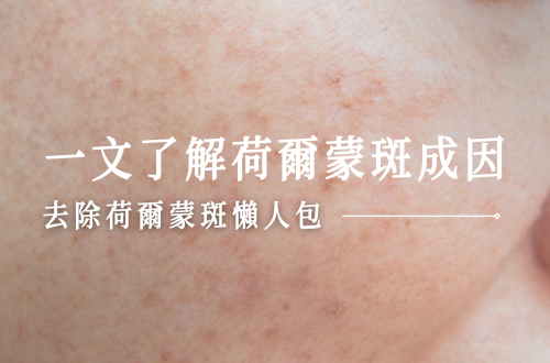 荷爾蒙斑懶人包