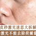 皮秒激光