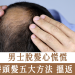 男士脫髮