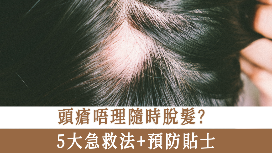 頭瘡唔理隨時脫髮？