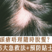 頭瘡唔理隨時脫髮？