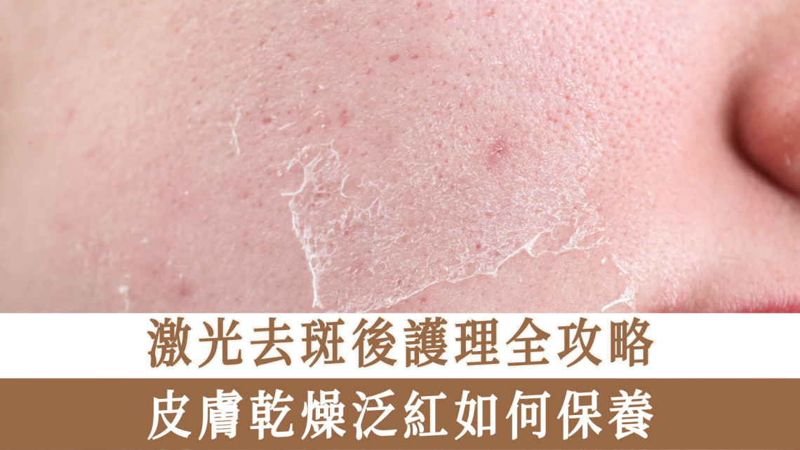 激光去斑後護理全攻略
