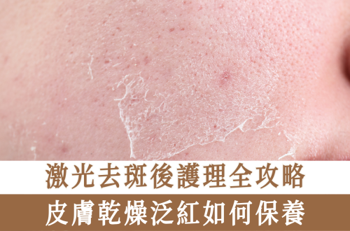 激光去斑後護理全攻略