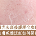 激光去斑後護理全攻略