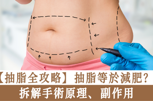 抽脂全攻略