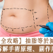 抽脂全攻略
