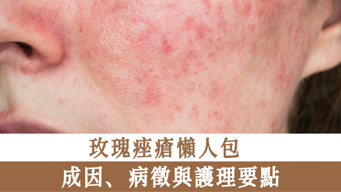 玫瑰痤瘡懶人包