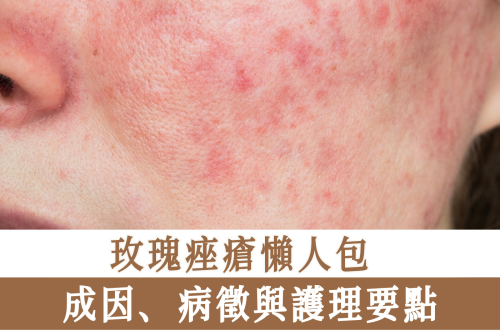 玫瑰痤瘡懶人包
