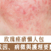 玫瑰痤瘡懶人包